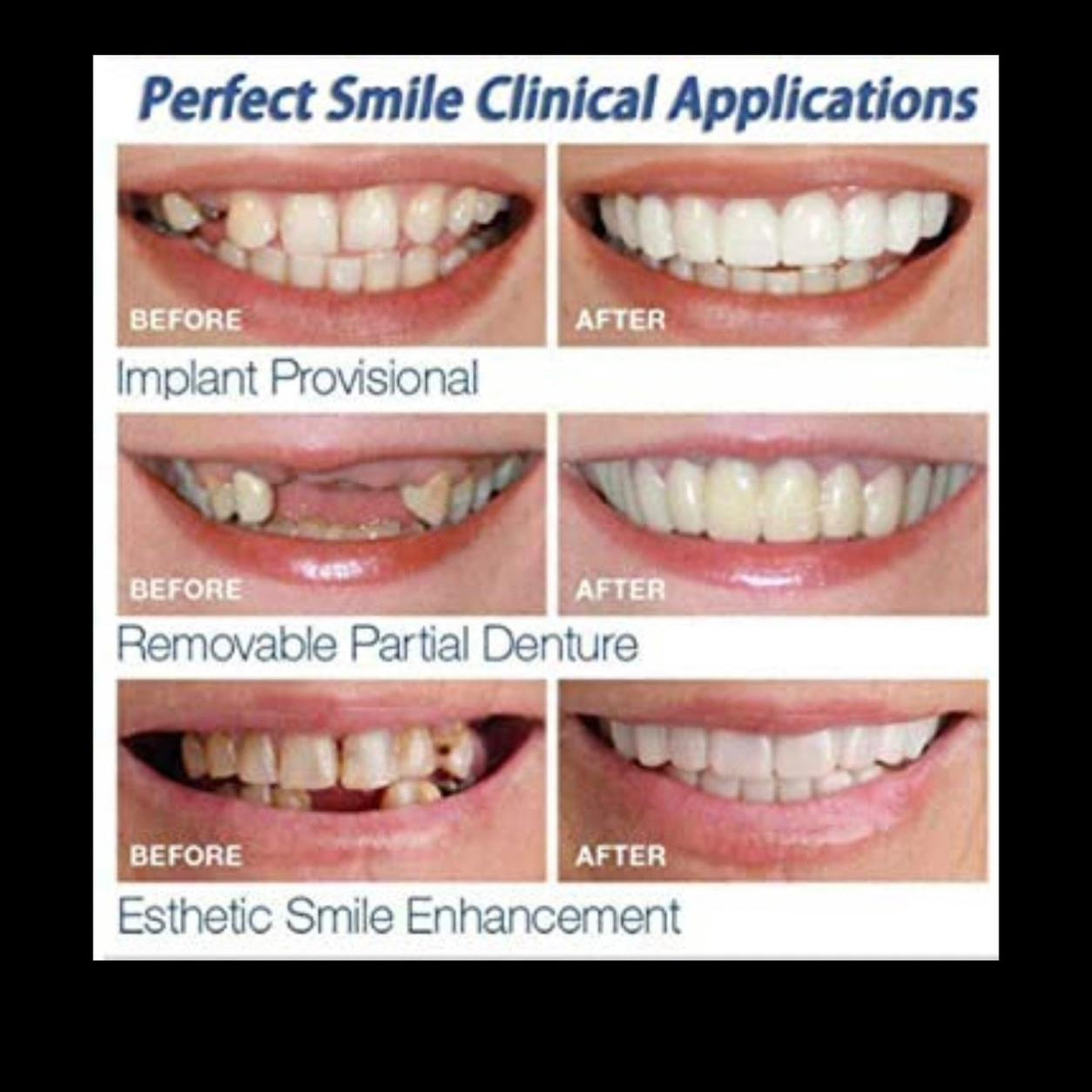 Snap-On Smile Veneers – Instant Hollywood Smile
