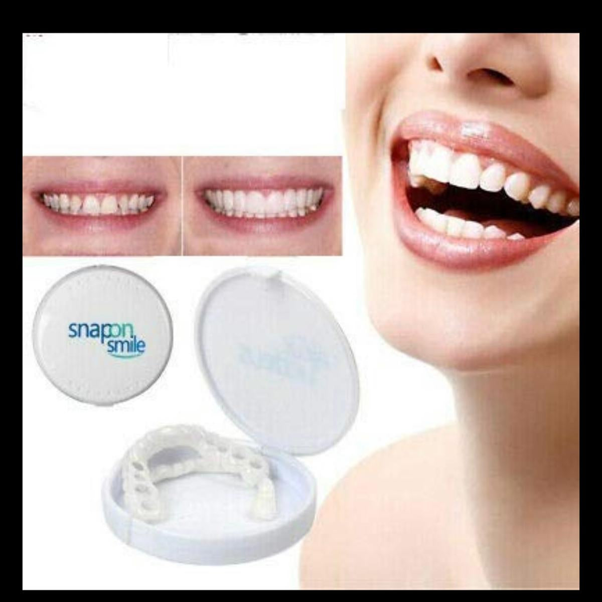 Snap-On Smile Veneers – Instant Hollywood Smile